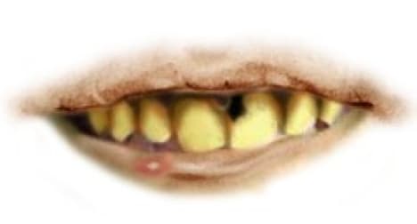 Dentist identifies robber by his teeth