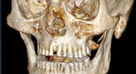 'Ötzi the Iceman had bad teeth': Zurich scientists