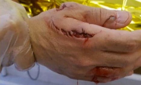 Pictured: Costa Blanca shark attack victim reveals wound