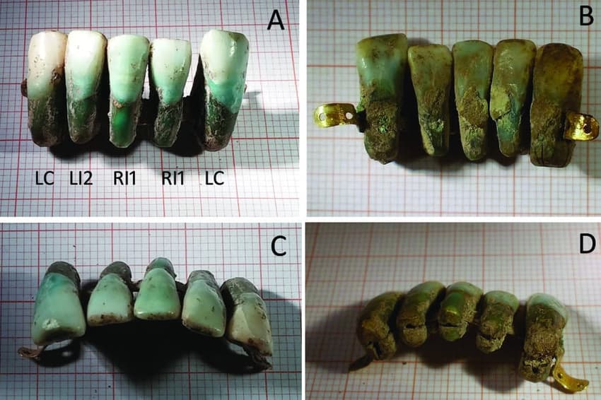 Italian archaeologists find 'world's oldest dentures'