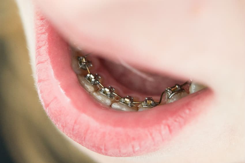 What is the cost of Braces in Berlin, Germany?