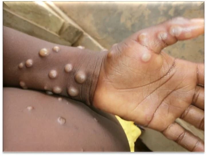 Italy reports first case of monkeypox