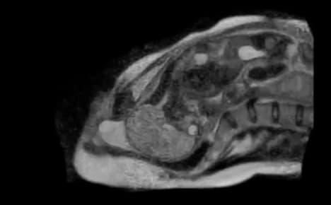 Berlin doctors release first MRI film of birth