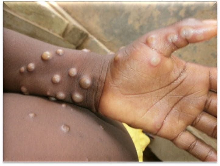 Eight suspected monkeypox cases detected in Spain 
