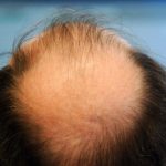 Stem cell hair follicle creates hope for the bald, lab animals