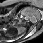 MRI scans live birth