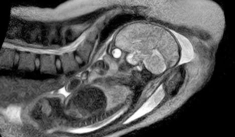 MRI scans live birth