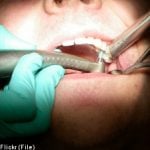 Patient swallows Swedish dentist’s drill bit