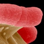 E. coli patients may need kidney transplants