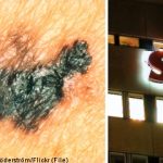 117 skin cancer cases misdiagnosed