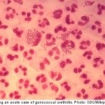 Gonorrhea cases on the rise in Sweden