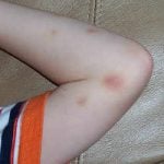 <b>Un bleu (bruise):</b> When you get hurt, the little mark that appears is simply called a “blue”. Photo: Flickr