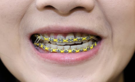 Massive jump in adult Swedes getting braces