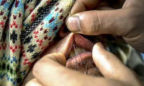 More Calais migrants stitch lips shut in protest