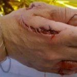 Pictured: Costa Blanca shark attack victim reveals wound