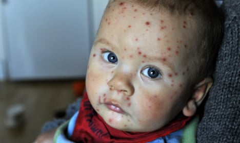 Sweden mulls universal chickenpox vaccinations for children