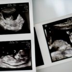 Norway approves pre-natal blood tests to detect Down syndrome