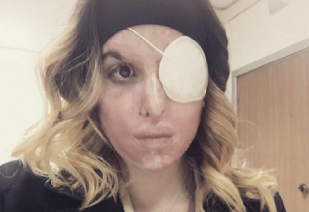 Italian acid attack victim shares defiant selfie showing her scars