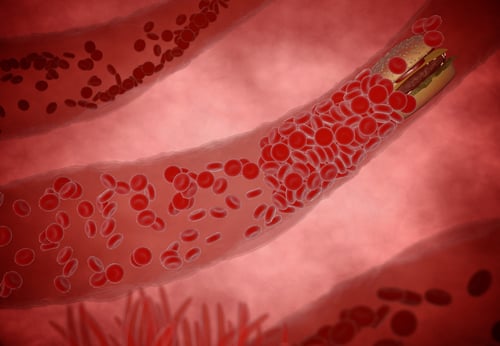 Spanish study reveals half of middle-aged people have hardened arteries