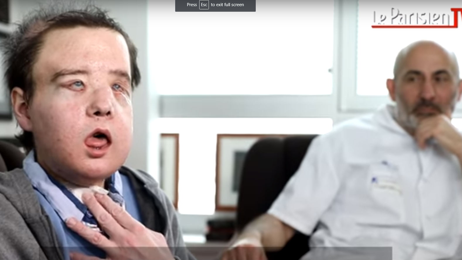 The Frenchman ‘with three faces’ speaks out after second transplant