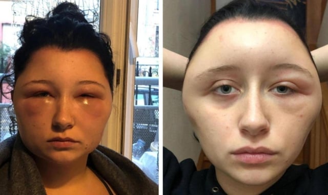 I almost died': Young French woman disfigured by hair dye