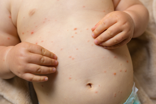 Why France is increasingly concerned about the steep rise in measles cases