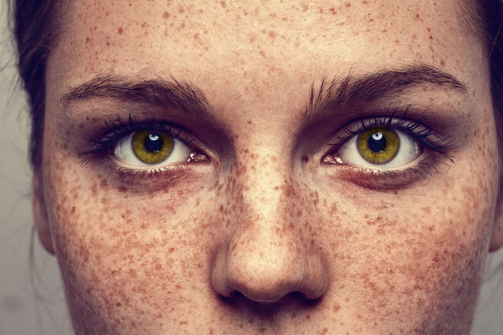 A close-up of a woman with prominent freckles.