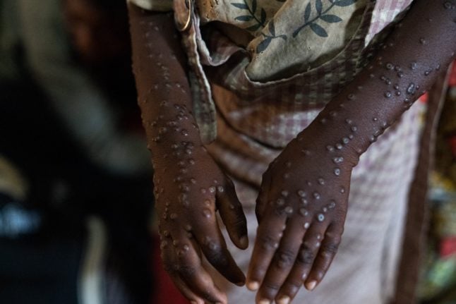 Spain to donate half a million mpox vaccines to Africa