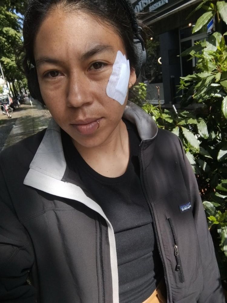 Emilia Ochoa seen with a bandage on her face some after being released from the hospital.